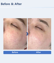 Load image into Gallery viewer, New Rowan Aqua Peel 4 Pro PLUS Complete Skincare Facial Aesthetic System with  Ultrasonic J-Peel, Electroporation and Electromyostimulation