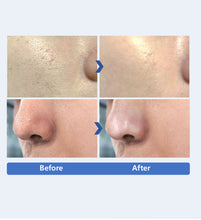 Load image into Gallery viewer, New Rowan Aqua Peel 4 Pro PLUS Complete Skincare Facial Aesthetic System with  Ultrasonic J-Peel, Electroporation and Electromyostimulation