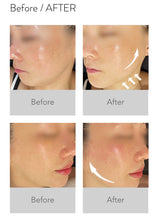 Load image into Gallery viewer, Thermatrix Fractional RF Skin Resurfacing Device with Perfect Pin Technology