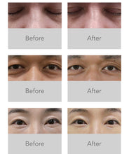 Load image into Gallery viewer, New I-Lift RF Diathermy Non Surgical Eyelift Dark Circle Removal System