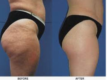 Load image into Gallery viewer, New S-Body Lipomassage+ Cavitation + Thermotherapy All in One Body Contouring, Cellulite and Lymphatic Drainage Machine