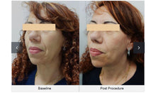 Load image into Gallery viewer, Th4 HIFU SONO MTS Facial Rejuvenation Hydration Skincare  System